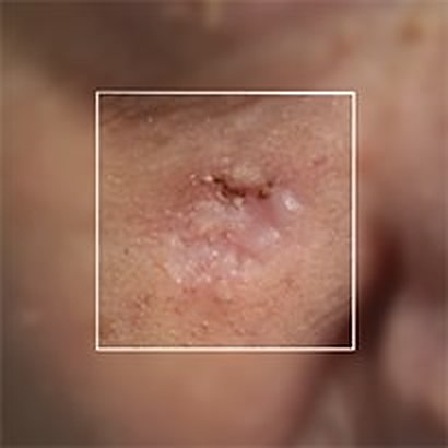 Stessa zona dopo l'asportazione con chirurgia laser