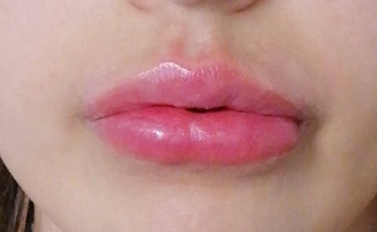 Labbra dopo il filler all'acido ialuronico
