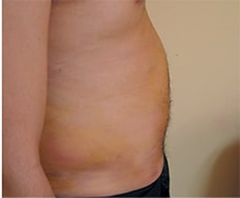 Addome di profilo dopo la liposcultura