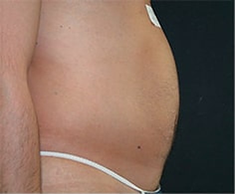 Addome di profilo prima della liposcultura