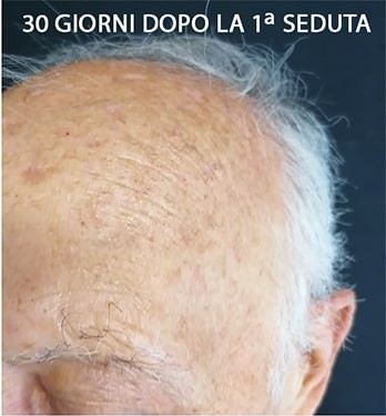 Stessa zona 30 giorni dopo la prima seduta laser